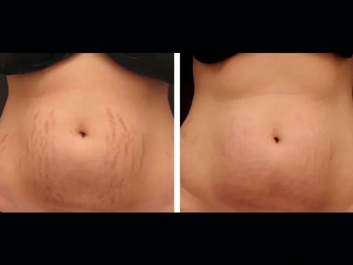 Unveil Youthful Beauty Using Radiofrequency (RF) Microneedling Treatments in Dubai