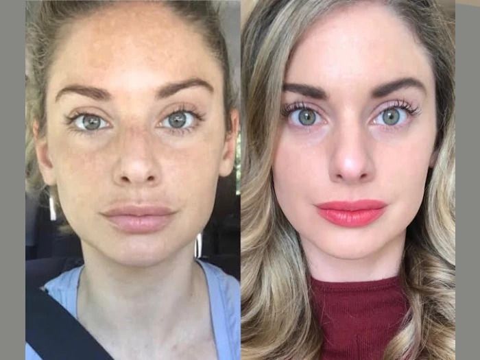 Natural Rejuvenation Results with RF Microneedling Best Doctors in Dubai