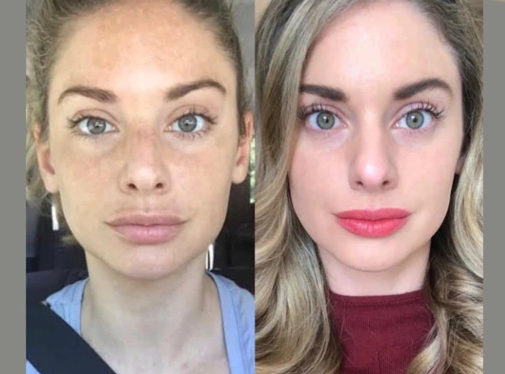 Best Doctors in Dubai for Radiofrequency (RF) Microneedling Facial Tightening