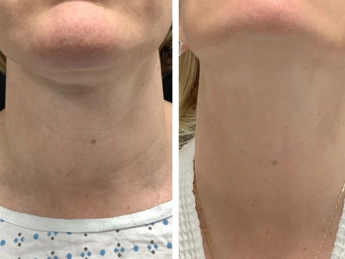 Radiofrequency (RF) Microneedling treatments in Dubai for Anti-Aging Solutions